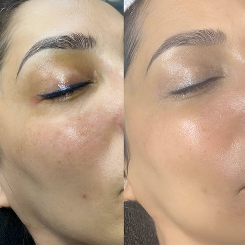 Before using Movataa Snail Face Cream