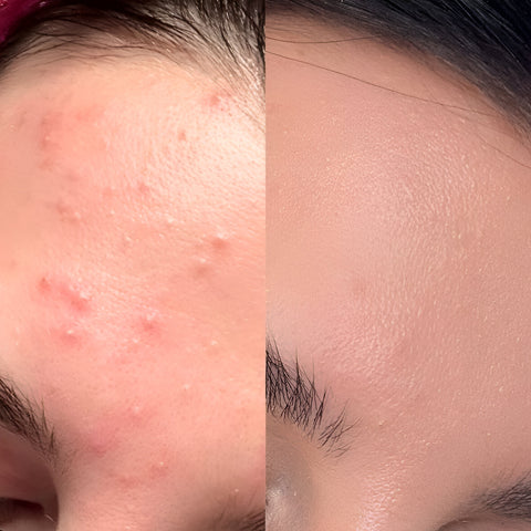 After 4 weeks of Movataa Snail Face Cream